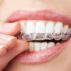 Tips For Treating Malocclusion