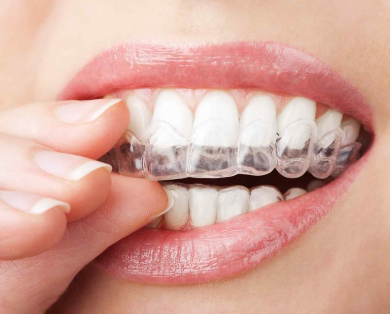 Tips For Treating Malocclusion