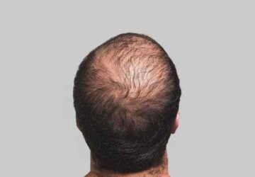 Effects of a Good Diet on Hair Loss