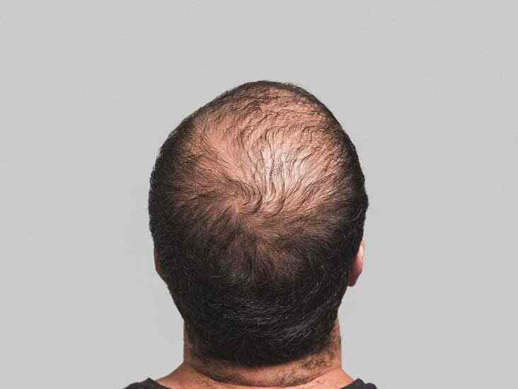 Effects of a Good Diet on Hair Loss