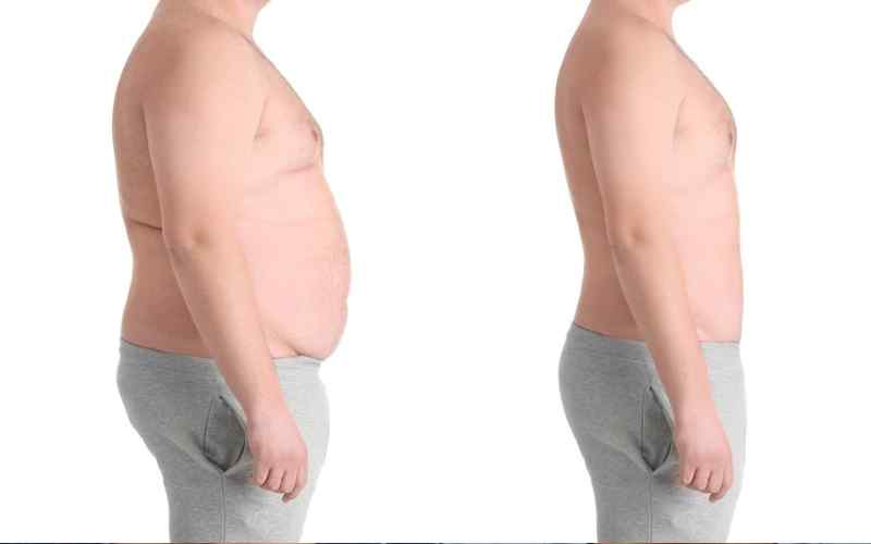 6 Reasons to consider weight loss surgery